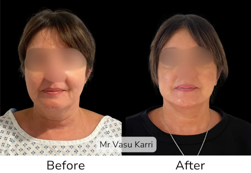 Facelift Patient 18 View 1